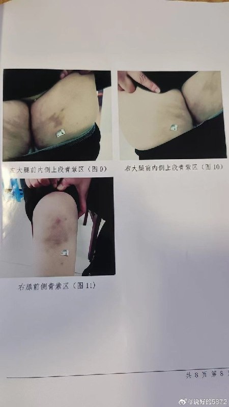 “人身安全保护令？废纸一张”7月28日，恩施市人民法院一审以虐待罪判处罗某有期徒刑六个月，湖北恩施家暴受害者商文娟的经历再次引发关注