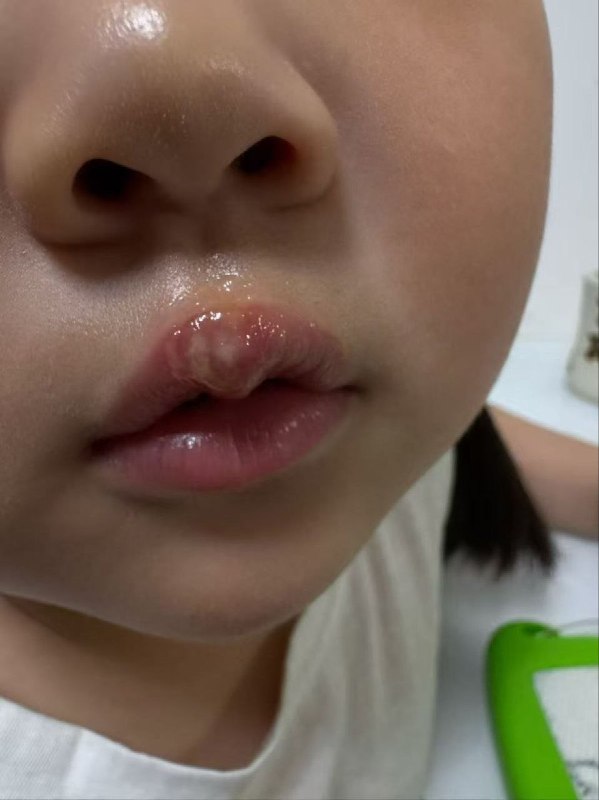 “丰县机关二幼老师用热熔胶笔烫孩子的嘴”5月27日，江苏省徐州市，丰县机关二幼翡翠园分校中九班，发生虐童事件