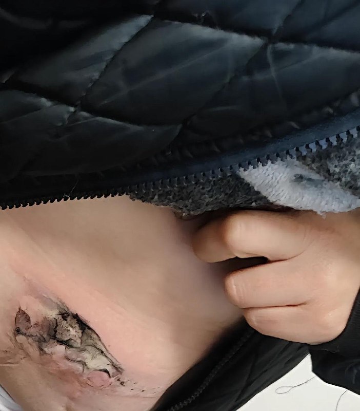 10 月 22 日，河南一女子在街头时，口袋中的红米 Note 13 Pro 手机突然爆炸